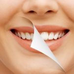 Smile Makeover - Kitsilano dentist