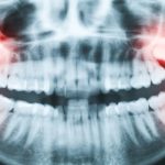 wisdom tooth fairview vancouver