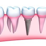 dental implants procedure