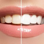 How Does Teeth Whitening Work